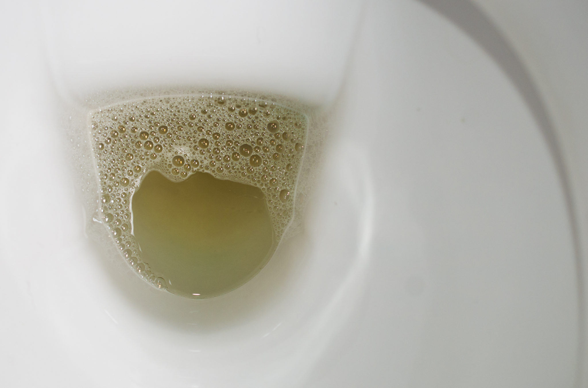 What Does White Urine Signify at Christopher Robertson blog