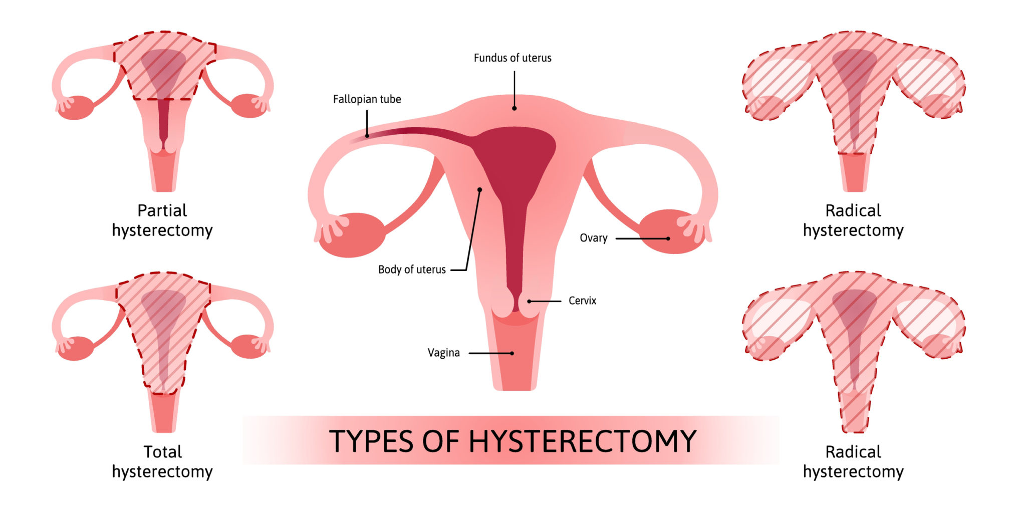 What Do They Take Out In A Hysterectomy