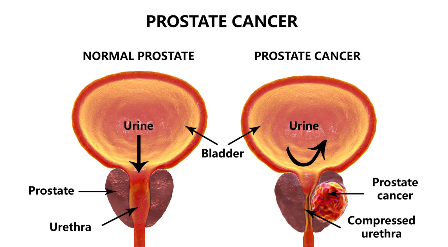 Stage 5 Prostate Cancer Survival Rate