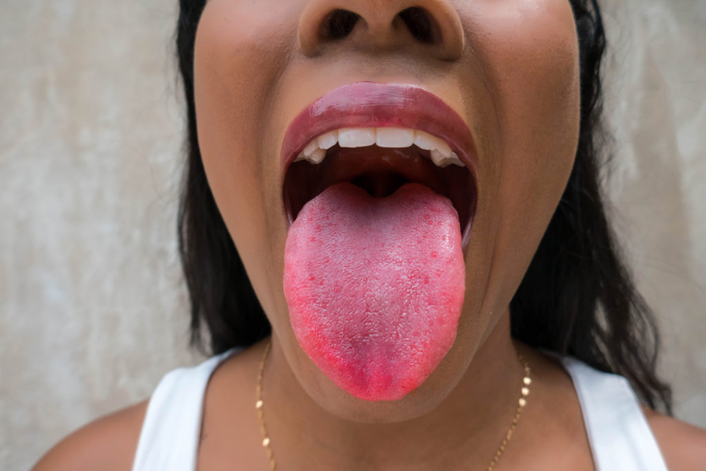 covid tongue