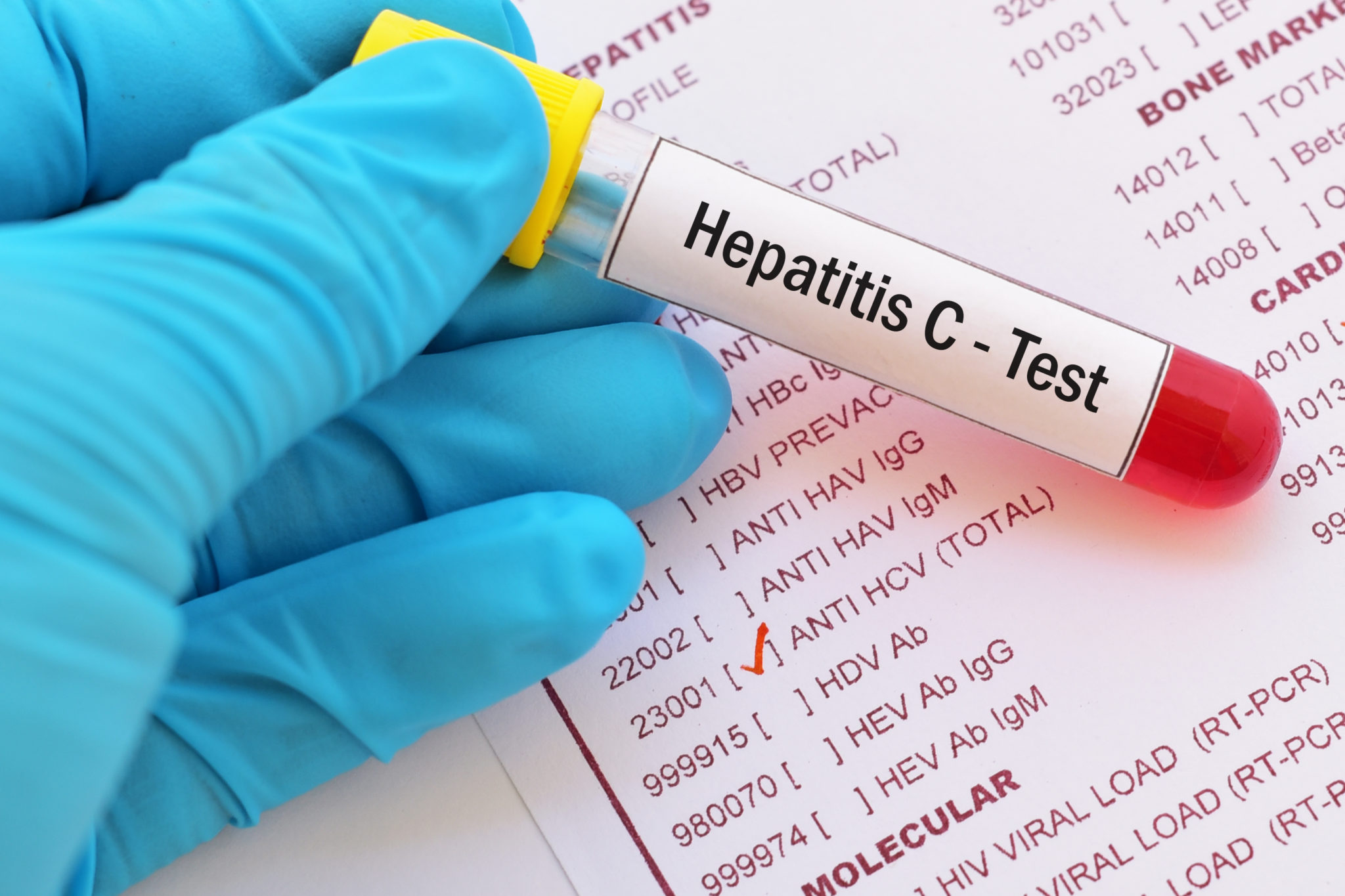 Do these four things to avoid a Hepatitis C Reinfection - BlackDoctor.org