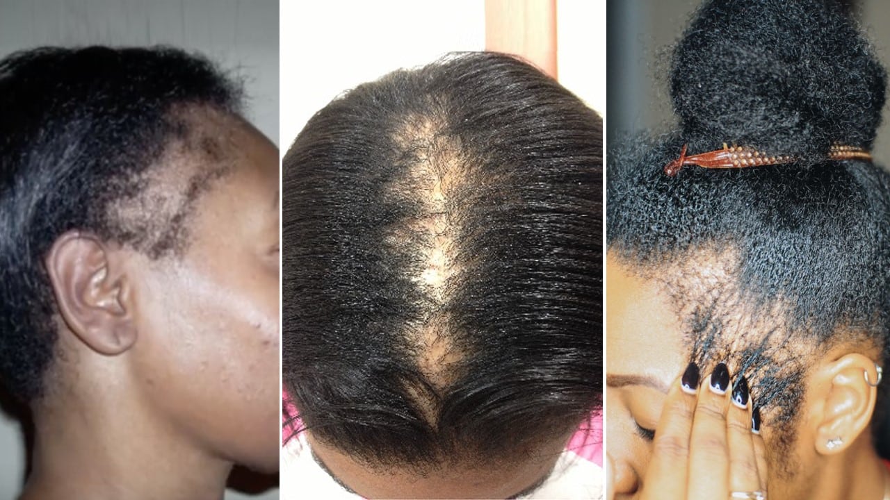 Diabetes and Hair Loss   Can Diabetes Cause Hair Loss