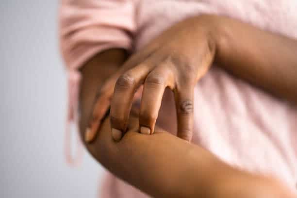 psoriasis