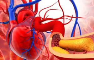 8 Signs You’re Living With Clogged Arteries - BlackDoctor.org