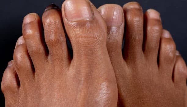 nail fungus treatment