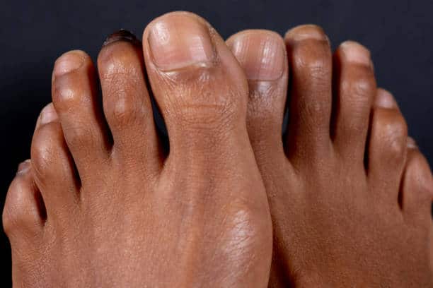 nail fungus treatment