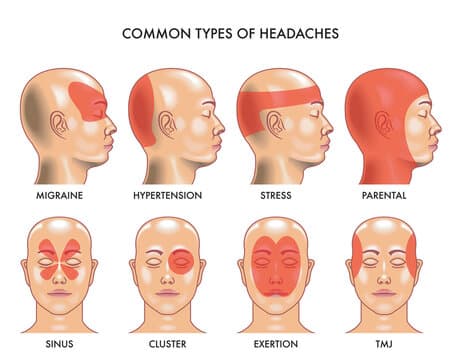 types of headaches chart