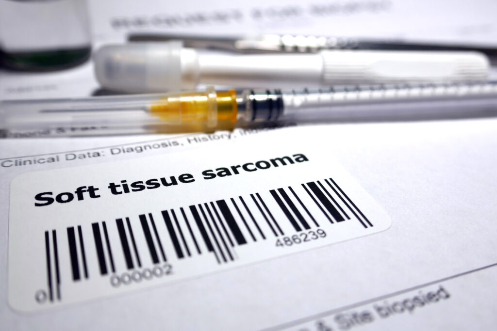 This Sarcoma Clinical Trial Reduces Risk of Relapse by 43%