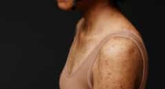 psoriasis scars