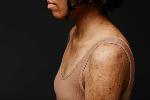 psoriasis scars