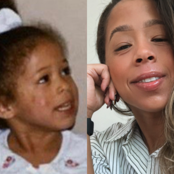Ashely Lora Did An Eczema Clinical Trial and Found Healing and Purpose