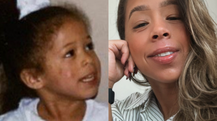 Ashely Lora Did An Eczema Clinical Trial and Found Healing and Purpose