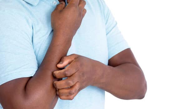 itchy skin, cholesterol